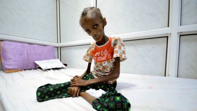 أطفال اليمن يموتون